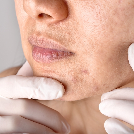 acne scarring on a woman's face