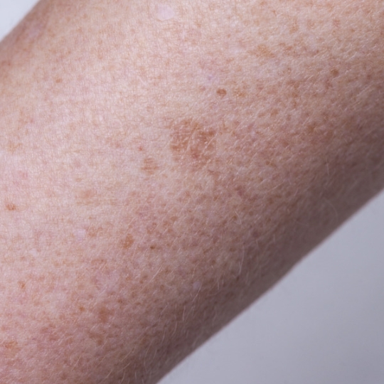 hyperpigmentation on the arm