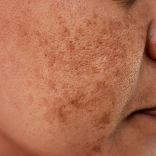 melasma on a woman's face