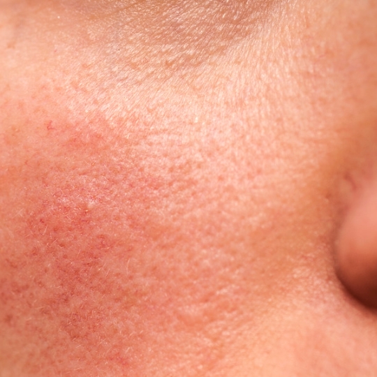 redness on the cheek of a woman