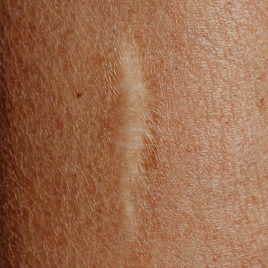 healed scar for privè skin peel