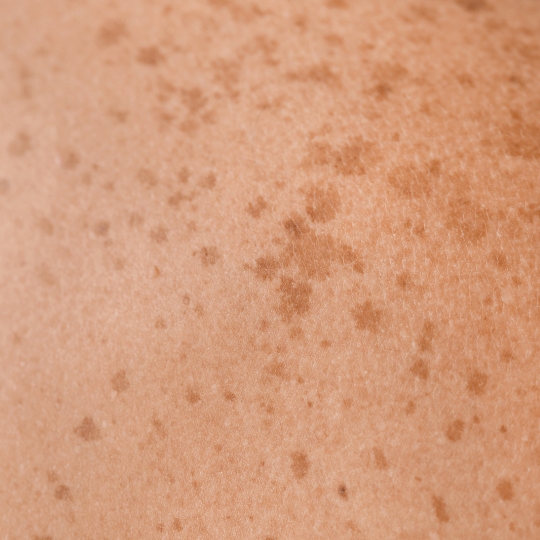 sunspots on the skin for privè chemical peel