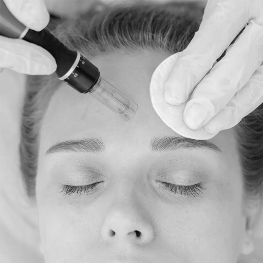 Microneedling - Treatment