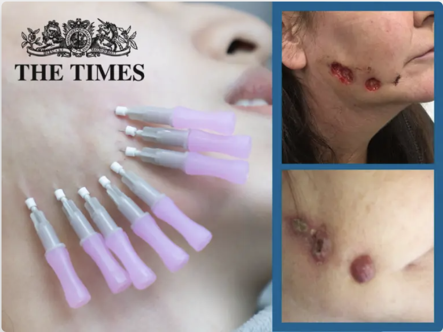 The Times: Unregulated facial ‘thread lifts’ put women in A&E